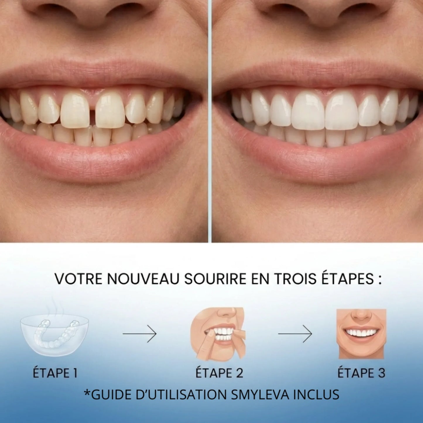 Facettes Adaptables & Amovibles